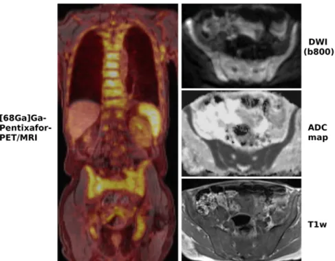 FIGURE 4: A 70-year-old patient with chronic lymphocytic leukemia (CLL) with clearly increased CXCR4 expression in the entire skeleton as well as axillary lymph nodes on [ 68 Ga]Ga-Pentixafor-PET/MRI