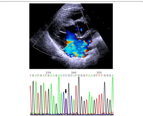 Fig. 1 Echocardiograph showing aortic root dilatation at the sinuses of Valsalva (line in-between two asterisks) and the sequencing result showing theheterozygous missense mutation c.3331 T > C in the patient (arrow)