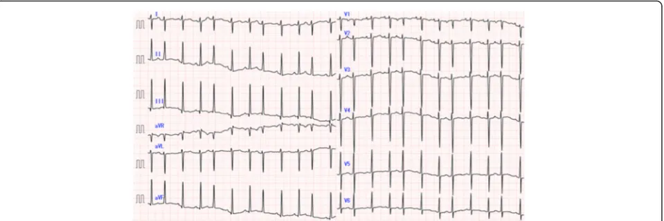 Fig. 3 Electrocardiography findings. Twelve-lead electrocardiography (ECG) revealed irregular tachycardia (139 bpm) and sporadic PSVC withoutST abnormality or wide QRS duration