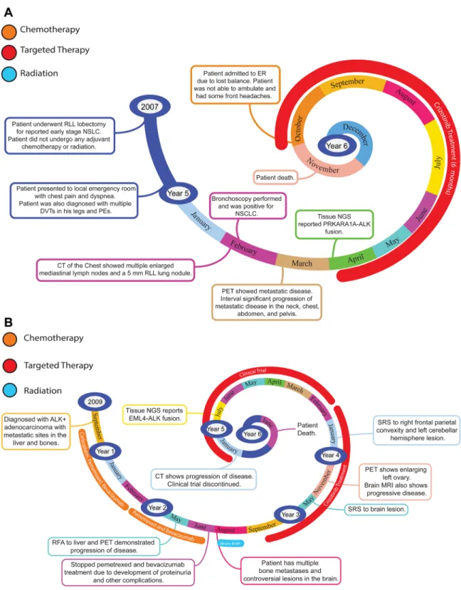 Figure 2: Representative timelines of patient treatment history.  (A) Timeline representation of straightforward case #1 with  ALK positive NSCLC which did not undergo any adjuvant chemotherapy or radiation and eventually progressed with diffuse metastatic