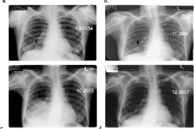 Fig. 1: Progress in the metastatic lung lesion in one of the patient.