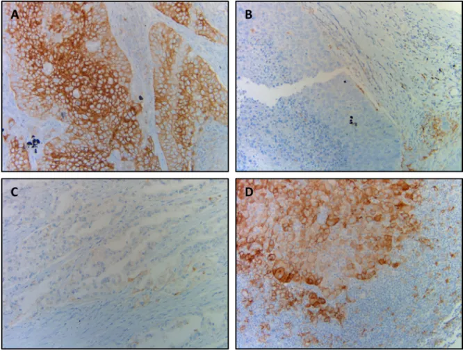 Figure 1: Representative photographs of discrepant PD-L1 expression between primary and metastatic tumors