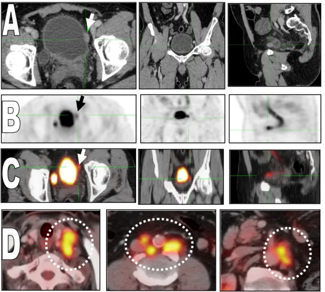 Fig. 1 62 years old male patient with urinary bladder mass (TCC). The administered activity is 370.4 MBq