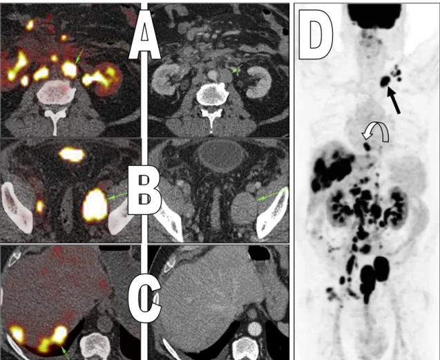 Fig. 2 64 years old male patient with urinary bladder mass (TCC). The administered activity is 379 MBq