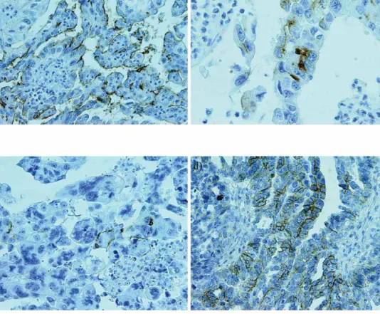 Figure 1. Immunoreaction in the high grade serous ovarian cancer and metastasis. a) High CD133 expression in the high grade  serous ovarian cancer (at the apical/endoluminal part of tumor cells)