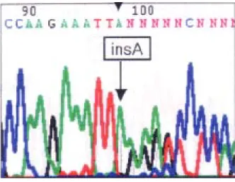 Fig. 1. Germline mutation of BRCA1 gene in clear cell ovarian cancer patient. Arrow indicates abnormally shifted DNA bands due to adenine insertion in nucleotide sequences of exon 11K of BRCA1 gene, which leads to frame shift change in translation and imma