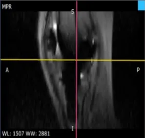 Figure 13: Alignment phase of the planning of an MRI scan.