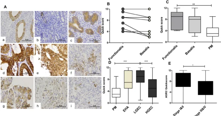 Figure 2: The immunoexpression of AGR2 in in normal and premalignant and malignant human endometrium
