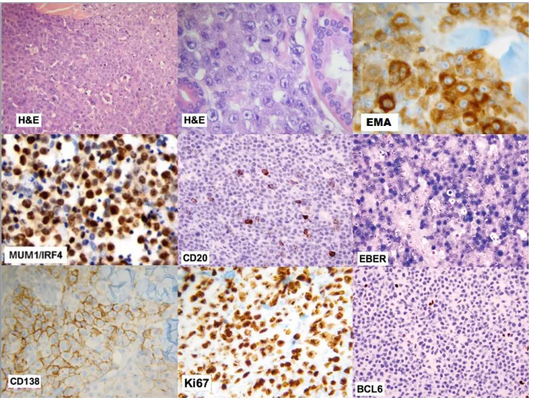 Figure  1.  H&amp;E:  Large  lymphoid  cells  with  plasmablastic  features,  haematoxylin  and  eosin  stain  (medium  and  high  resolution); 