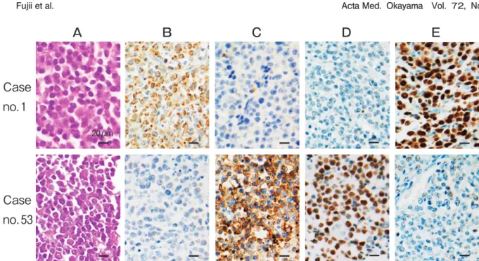 Fig. 2　 Tissue array samples (2 cases) of hematoxylin-eosin stain (A) and immunostains (B,  A20; C,  CD10; D,  BCL6; E,  MUM1),   (Olympus BX51).