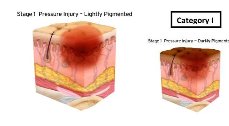 Figure 2.7.   Category I Pressure ulcer [24] 