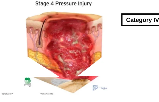 Figure 2.10.  Category IV Pressure ulcer [24] 