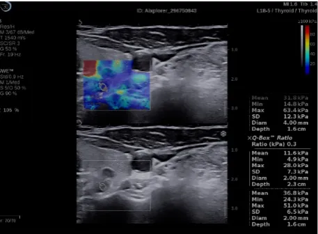 Figure 1. (a) 2 B-mode ultrasound evaluation of parathyroid hyperplasia, visualizing parathyroid hyperplasia in color dopple-r mode; (b) elastogram overlapping B-mode image of parathyroid hyperplasia, color map of tissue elasticity