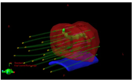 Figure 2. Three-dimensional image with simulation of radiation (red: prostate, green: urethra, blue: 