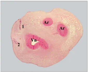 Fig. 5.  Folded scalloped surfaces, reduced differentiation  of the Wharton’s jelly, variable density of the matrix cellular 