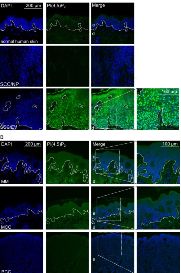 Figure 4: High nuclear PI(4,5)P 2  levels in human keratinocyte skin cancer.  (A) Representative immunofluorescence staining  for PI(4,5)P 2  in normal human skin, skin SCC of the normal population (SCC/NP) and HPV8 positive EV-SCC