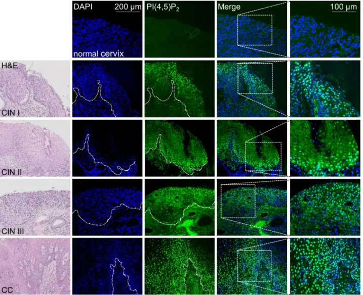 Figure 5: Enhanced nuclear PI(4,5)P 2  levels in HPV16 positive cervical tumors.  Representative immunofluorescence staining  for PI(4,5)P 2  in normal cervix (n = 3), and HPV16 positive CIN I (n = 3), CIN II (n = 5), CIN III (n = 11) and cervical cancer (