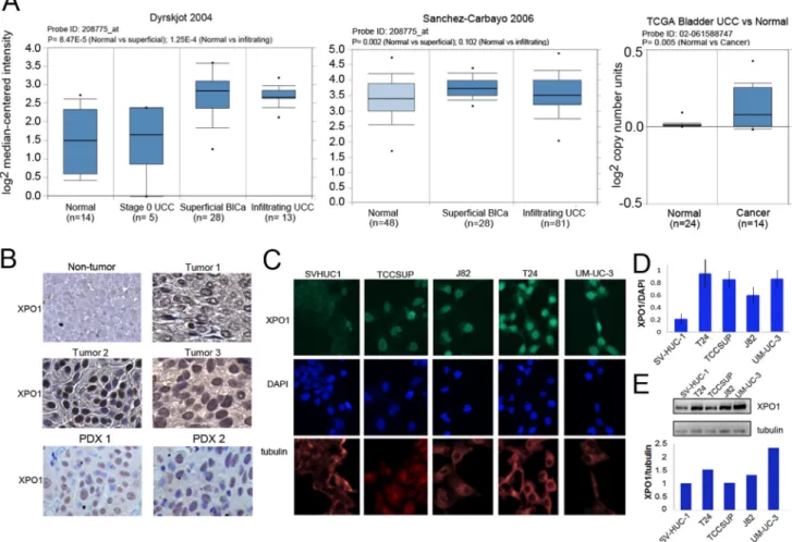 Figure 1: Expression of XPO1 in bladder tumor cells.  (A) XPO1 expression in normal and bladder cancer from the indicated  ONCOMINE datasets