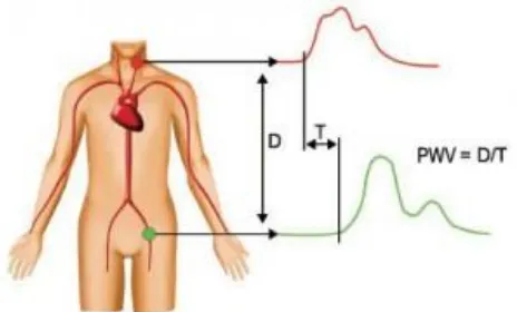 Figure 2: The golden standard for arterial stiffening estimation is the cfPWV method. Two pulse  sensors are placed at the carotid and femoralis artery