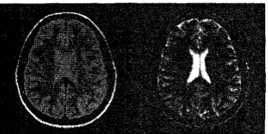 Fig. 1: A typical dual-echo Mli brain slice: the left one PDW IS and the right one is T2W