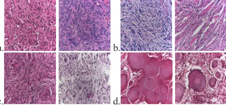 Figure 1: Various Meningioma Images belonging to each subtype a. Meningiothelial, b.Fibroblastic, c