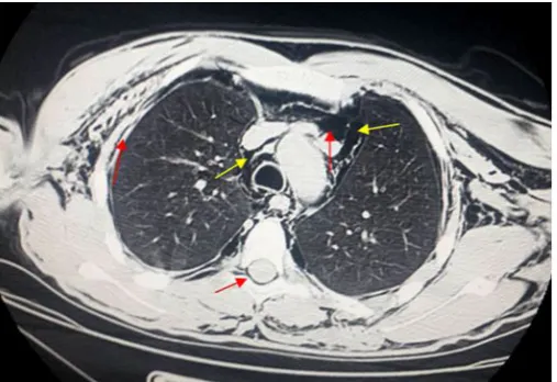 Figure 1: Diffuse cervico-thoracic subcutaneous emphysema reaching up to the occulo-palpebral region without petechiae 