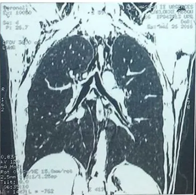 Figure 6: Pelvic scan with rectal opacification of the digestive organs: objectifying a rectal fistula with extravasation of the contrast products (Red arrow) to 6 cm from the anal margin