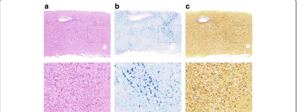 Fig. 1 Liver biopsy histology of case 1. Histological sections stained with a H&E, b Perls, and c Van Gieson’s stain showing significant stainableiron, without pathology