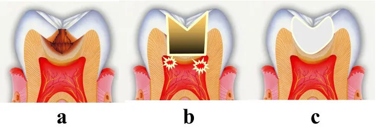 Figure 1. Conventional and minimal invasive caries treatments: (a) cavitated dentin caries; (b) in the conventional restorations, sound dentin was sacrificed to obtain mechanical retention of the restorations; (c) minimal cavity preparation can be achieved