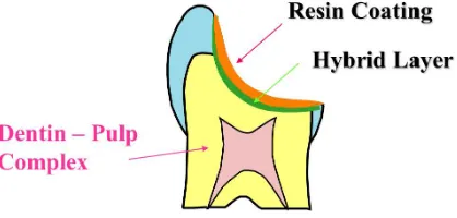 Figure 6. The resin coating technique produces a hybrid layer and tight sealing film on the dentin surface and protect dentin-pulp complex