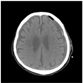 Figure 1A: Preoperative CT revealing a hypodense subdural hematoma over the left frontoparietotemporal region, causing a midline shift to the right and compression of the ipsilateral lateral ventricle