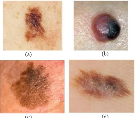 Fig. 1. Malignant Melanoma Types. (a) Superficial Spreading Melanoma. (b) Nodular Melanoma (c) Lentigo malignant Melanoma