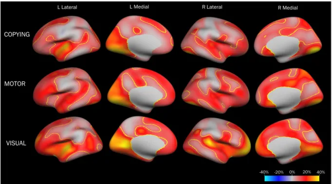 Fig. 3. Cortical thickness maps of explained variance in the VLBW group for VMI visual test scores, shown without and with suprathreshold labeling