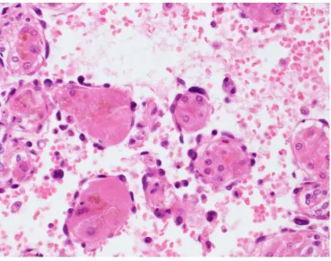 Figure 4: H&E Stain, autopsy liver. The tumour cells line dilated sinusoids, using thickened liver cell plates as a “scaf-fold”