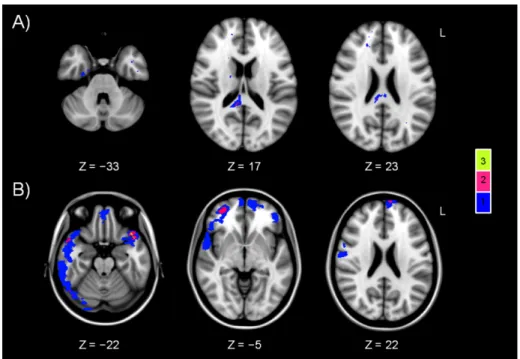Figure 4-2. Distribution and frequency of focal lesions. (A) white matter lesions visible on gradient-echo imaging and (B)  contusions