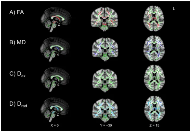 Figure  4-4.  Patients  with  microbleed  evidence  of  DAI  (MB)  show  more  extensive  white  matter  damage  than  patients  without microbleeds (Non-MB)