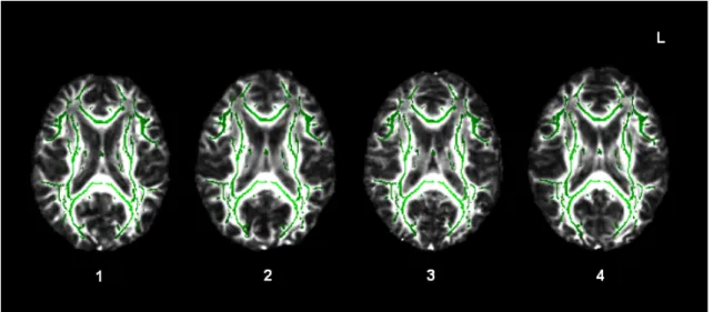 Figure  2-3.  Alignment  of  the  mean  FA  skeleton  with  individual  patients’  white  matter  tracts