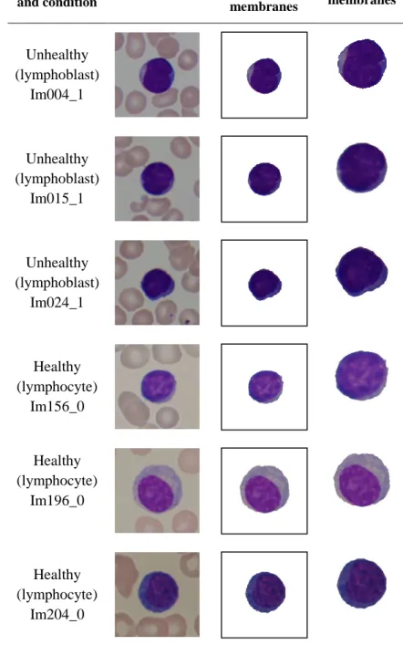 Figure 3.2 The sub-image microscopic blood samples of the lymphocytic  cells with ground truths and annotations from the haematologists Lymphocytic 