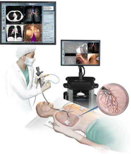 Figure 1. Visualization of a flexible bronchoscopic procedure. Retrieved from http://iacharitygolf.com/ project/electromagnetic-bronchoscopy/ on 16-08-2018 