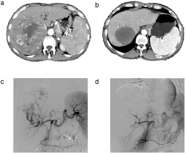 Figure 1: a.  Contrast-enhanced CT scan done before the procedure in the patient with HCC, b