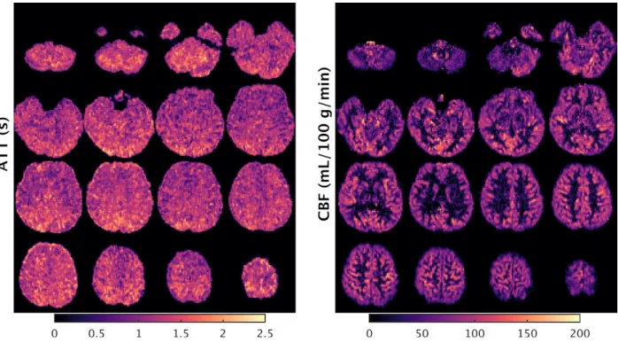 Figure 5 (color). High spatial resolution 2D MB-EPI PCASL. An example subject’s (male, 21 years old)                                 arterial transit time (ATT) and cerebral blood flow (CBF) maps acquired using 2D MB-EPI PCASL with                  high sp
