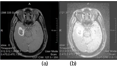 Figure 6 Histogram equalization of brain MRI, (a) original image, (b) enhanced image. 