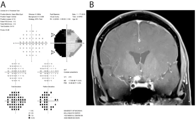 Figure 2: Functional and structural cause of vision loss in Case 103.  Two years following negative cytology results from  intraocular liquid biopsies in each eye, the patient developed severe vision loss in the left eye