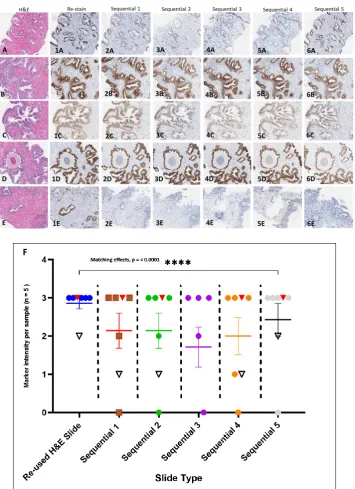 Figure 5.Figure 5. H&E stained slide image and reused H&E slide selected antibody immunostain comparison with sequential slides in PCa CNBs