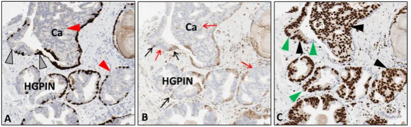 Figure 2.Figure 2. Sequential slides of human prostate tissue exhibiting cancer (Ca) invading into normal glands and high-grade prostatic intraepithelial neoplasia (HGPIN)