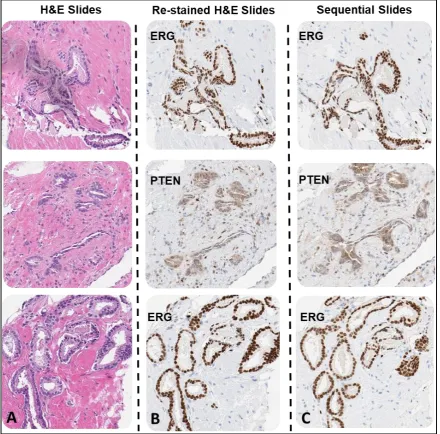 Figure 3.for biomarker loss or positivity to demonstrate tumor heterogeneity (B). The additional sequentialslides for each sample were stained with anti-PTEN antibody or anti-ERG antibody (C)