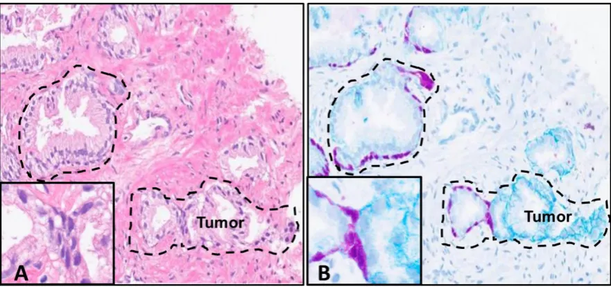 Figure 4. with 60The anti-HMWCKpanel) (Figure 4.Prostate adenocarcinoma sample CNB H&E and Chromogen IHC