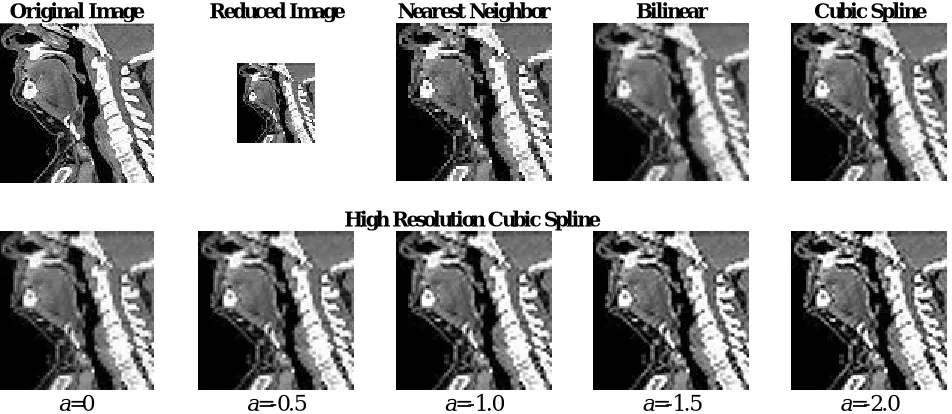 Figure 12  PSNR comparison of image of neckbone zoomed using nearest neighbor, bilinear, cubic and high resolution cubic spline 2 dimensional functions