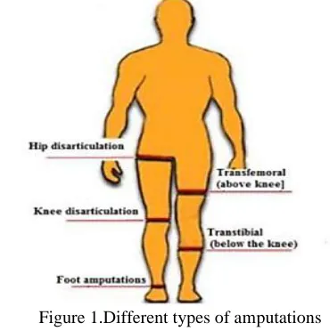 Figure 1.Different types of amputations 