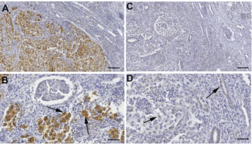 Figure 5: Keap1 protein expression by immunohistochemical analysis.  (A–B) Microphotographs are from a ccRCC sample  negative for KEAP1 promoter methylation